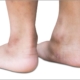 A recent study examined the effect of Kinesio Taping (KT) effect on balance and foot arches in young people with intellectual disability.