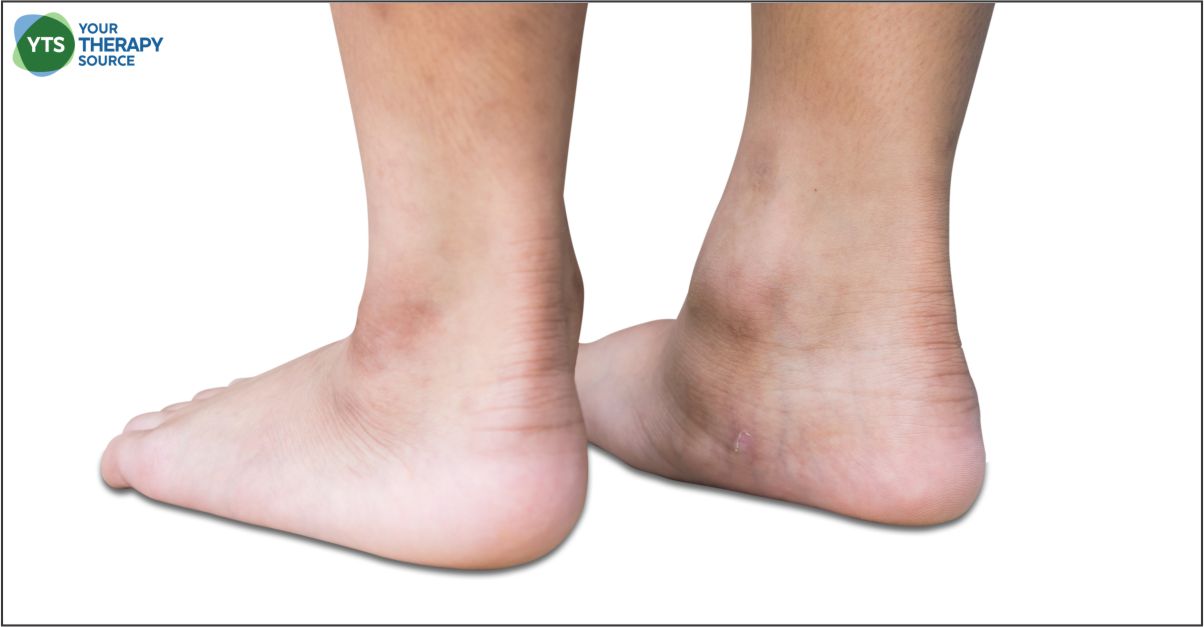 A recent study examined the effect of Kinesio Taping (KT) effect on balance and foot arches in young people with intellectual disability.